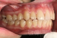 矯正後-右