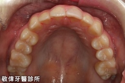 矯正後-上