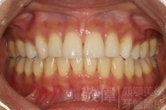 矯正後-正