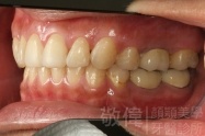 治療後-左